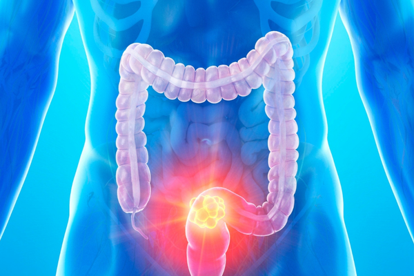 image of body for colorectal cancer
